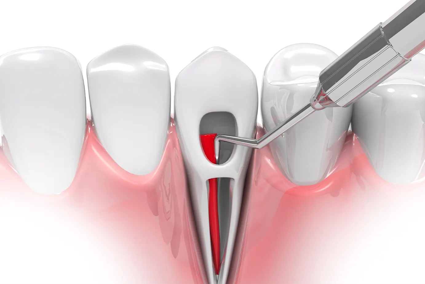 7 Signs Your Root Canal Has Failed Premier Endodontics of SouthPark